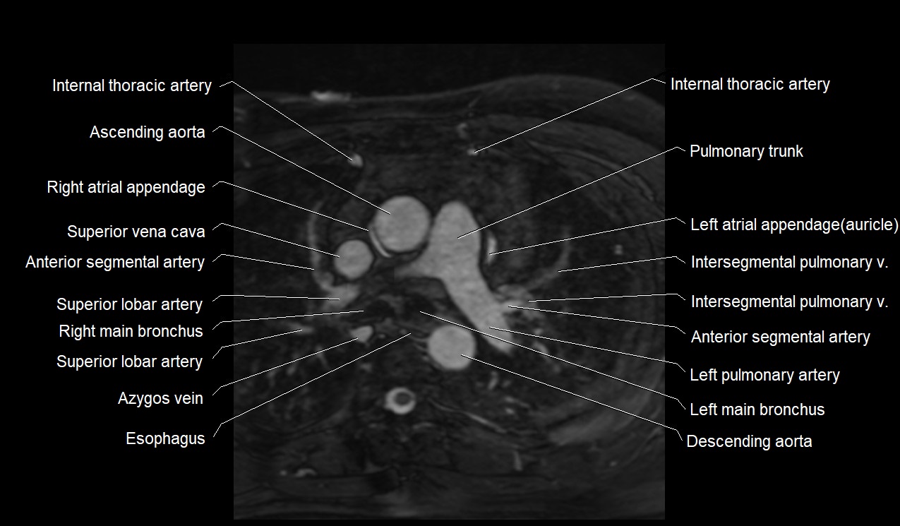 MRI heart coronary arteries and coronary veins anatomy axial image 2.jpg